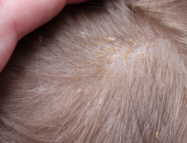 cradle cap #t2hmkr