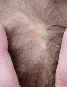 cradle cap #t2hmkr
