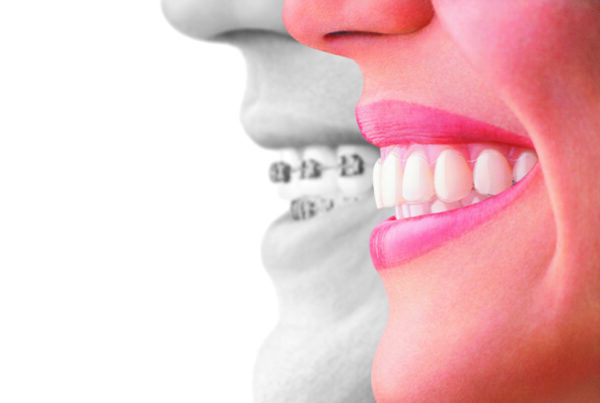 Invisalign Compared to Braces  -- Titus 2 Homemaker  #t2hmkr #InvisalignTalk
